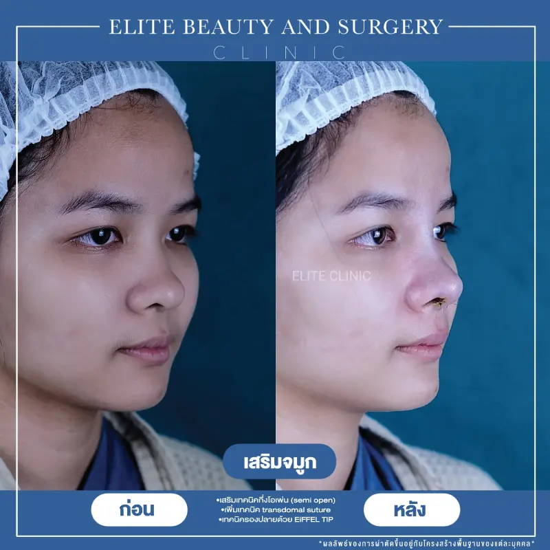 หมอเบียร์ ทีมแพทย์ ELITE