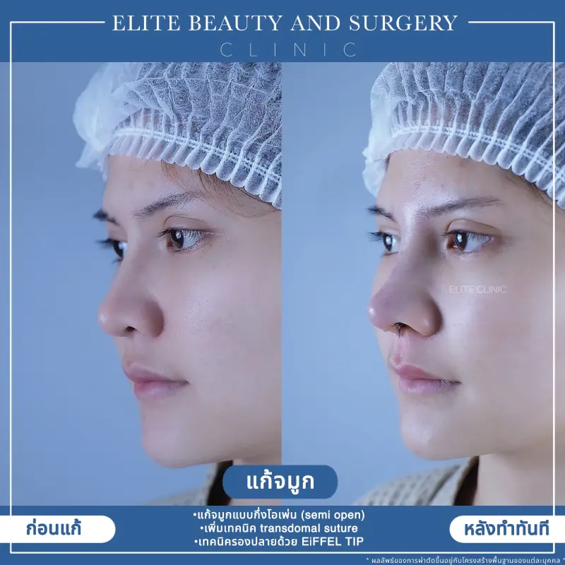 HIFU Threadlift เชียงราย